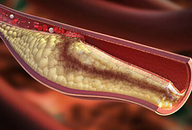 Высокий уровень холестерина в крови: признаки и симптомы