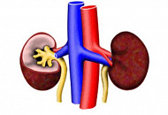 Окислительный стресс, вызванный гемодиализом у больных с терминальной стадией почечной недостаточности
