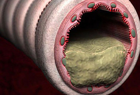 Неправильное питание: скопление слизи в организме